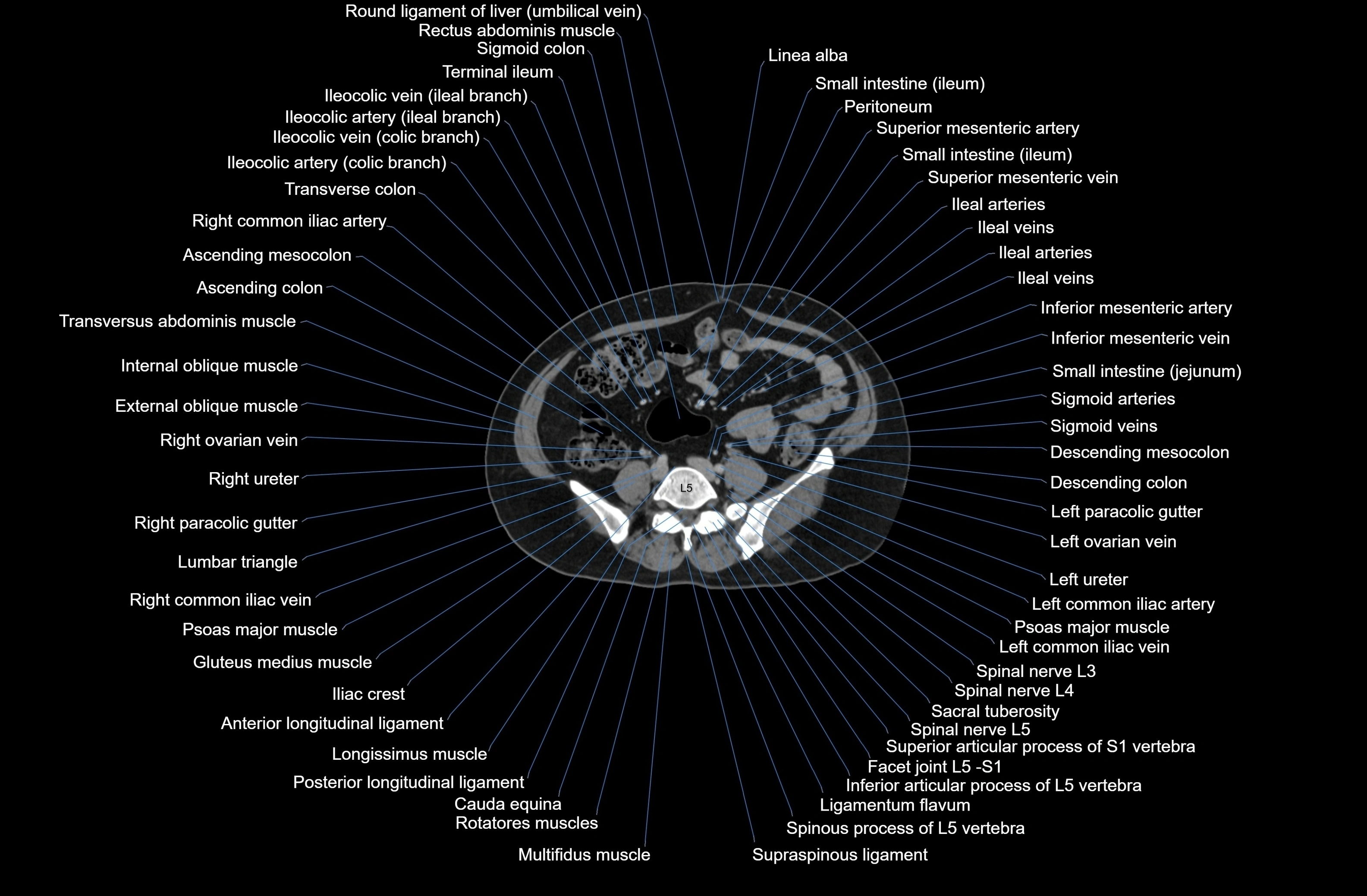 CT Abdomen axial cross sectional anatomy labelled radiology image-00060.webp